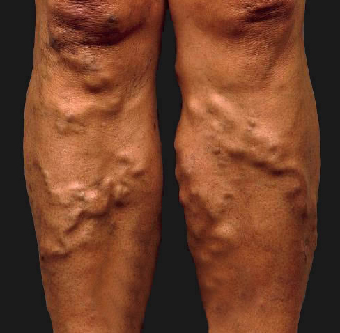 venous